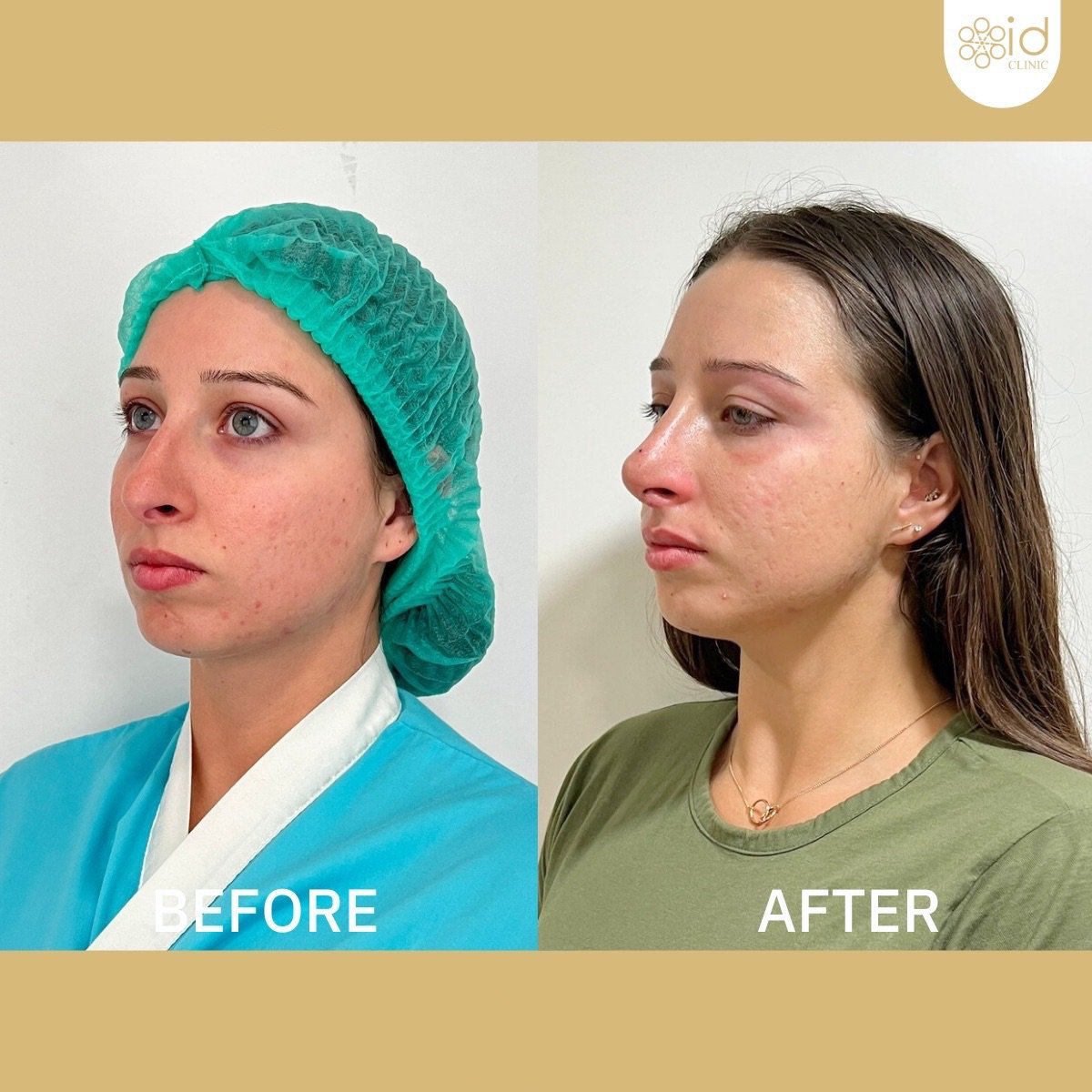 Before and after septoplasty results at ID Clinic Bangkok for deviated septum correction