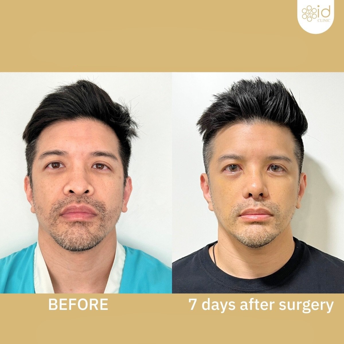 Before and after septoplasty results at ID Clinic Bangkok, improved nasal symmetry visible