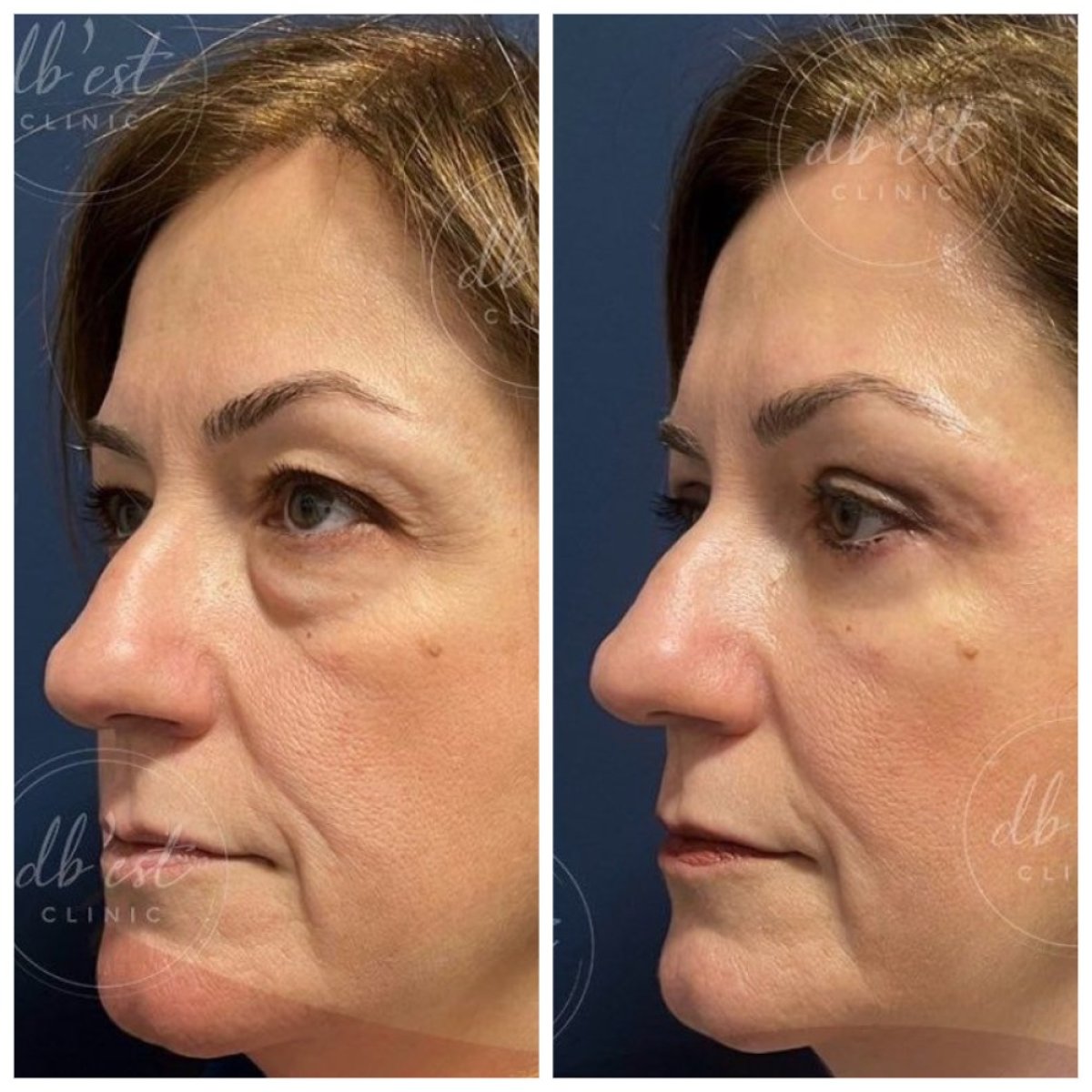Résultats avant/après blépharoplastie des paupières inférieures à Db'est Clinic, poches réduites