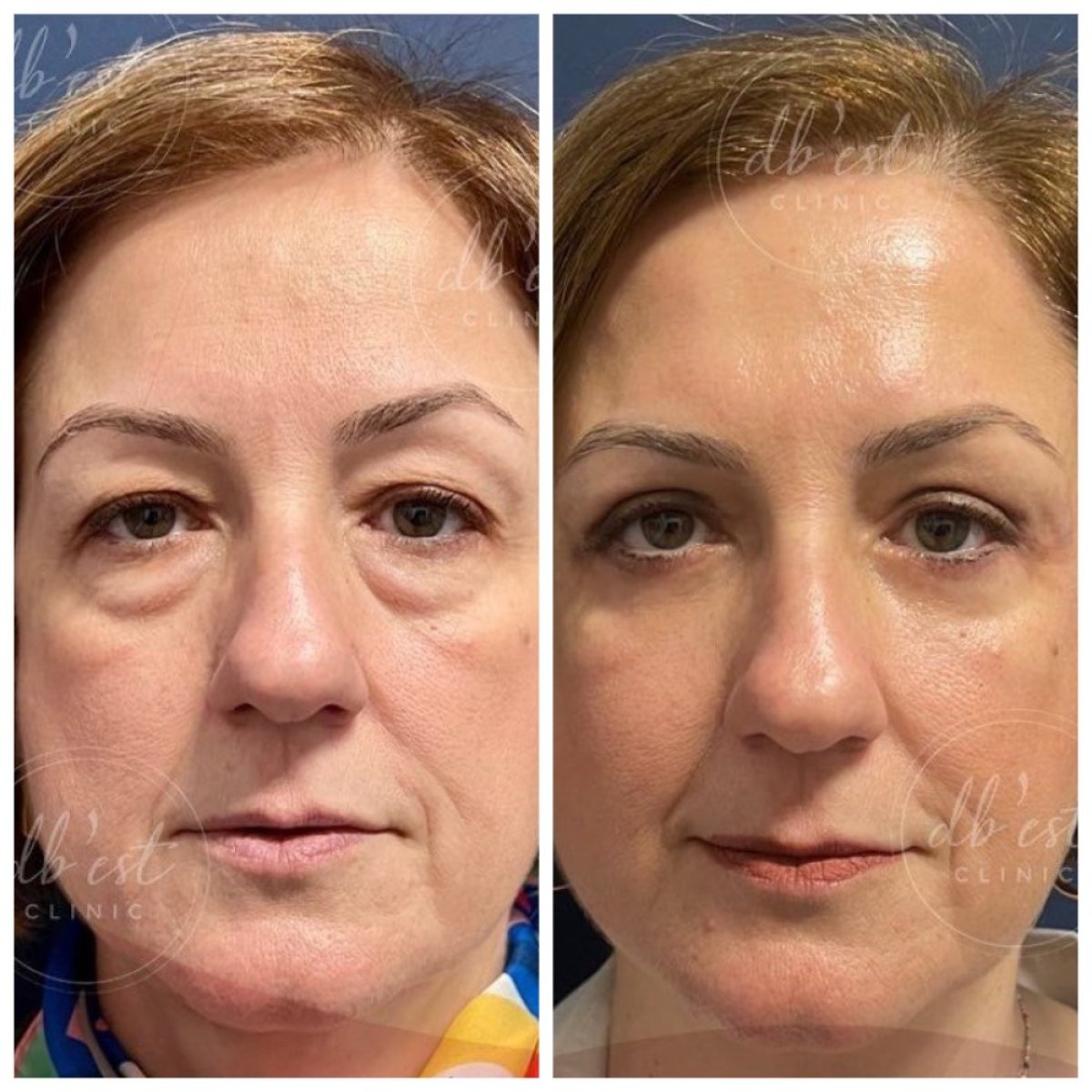 Before and after lower eyelid blepharoplasty results at Db'est Clinic, reduced under-eye bags