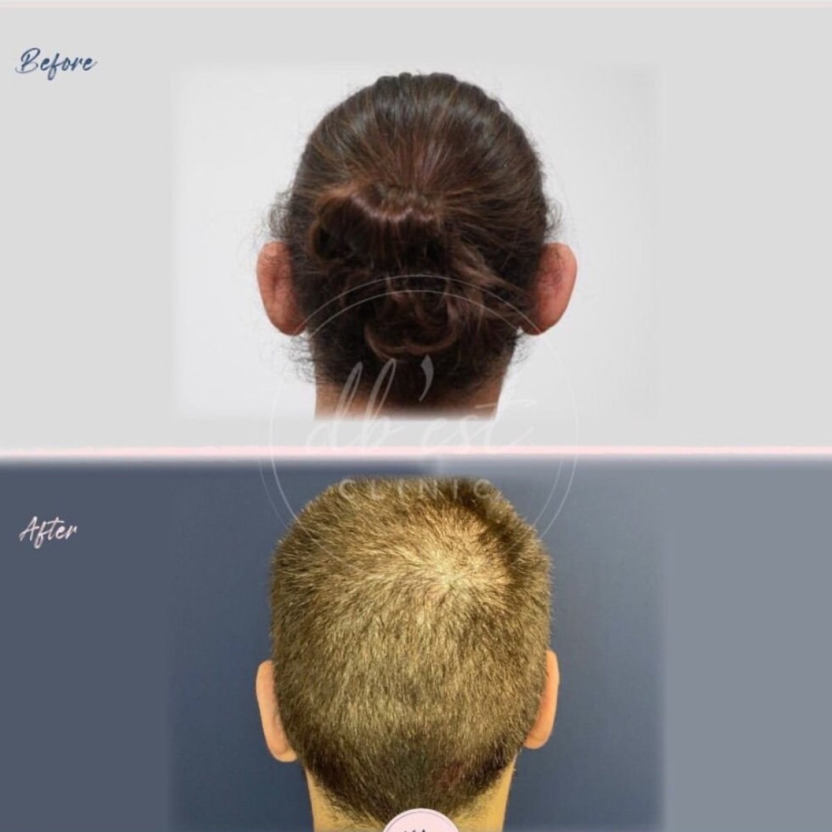 نتائج عملية تجميل الأذن قبل وبعد في Db'est Clinic – تحسين شكل ووضع الأذنين