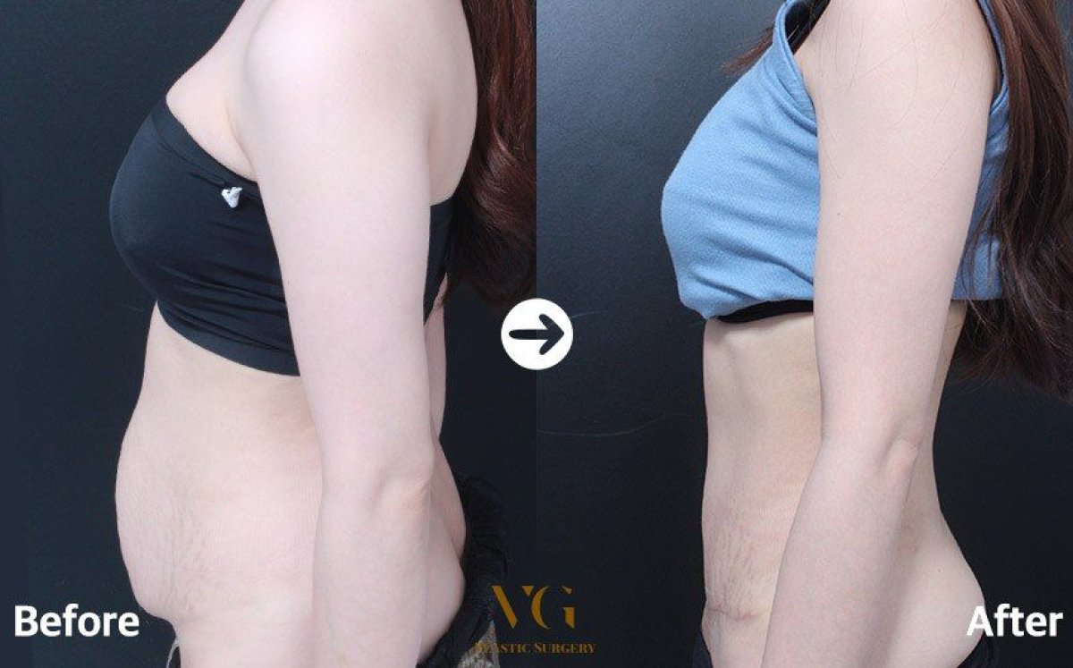 Before and after tummy tuck results at VG Plastic Surgery – visible abdominal contour improvement
