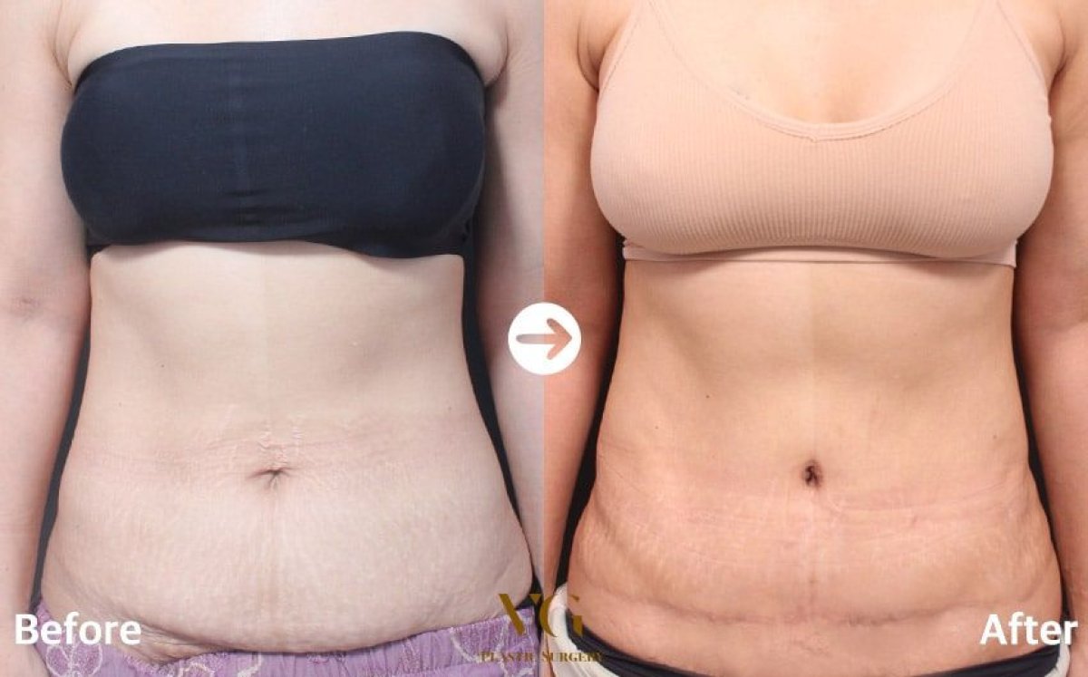 Before and after Vaser 3 areas plus tummy tuck results at VG Plastic Surgery clinic