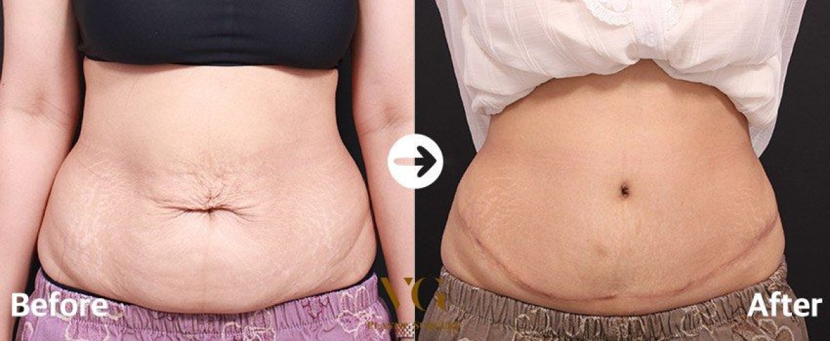 Before and after Vaser 3 Areas plus tummy tuck results at VG Plastic Surgery, flatter abdomen