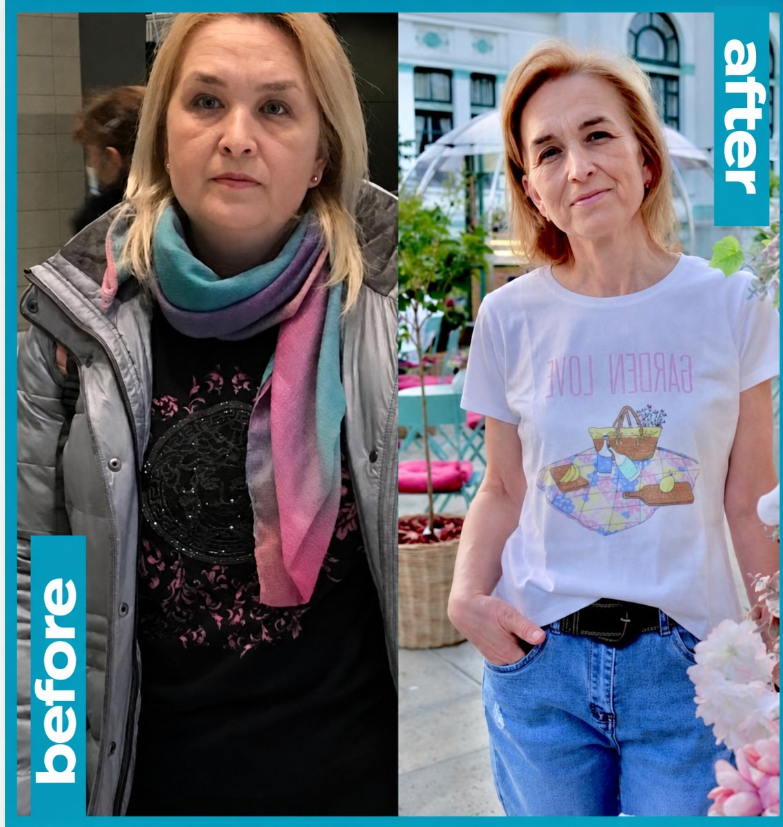 Before and after gastric sleeve surgery results – significant weight loss transformation