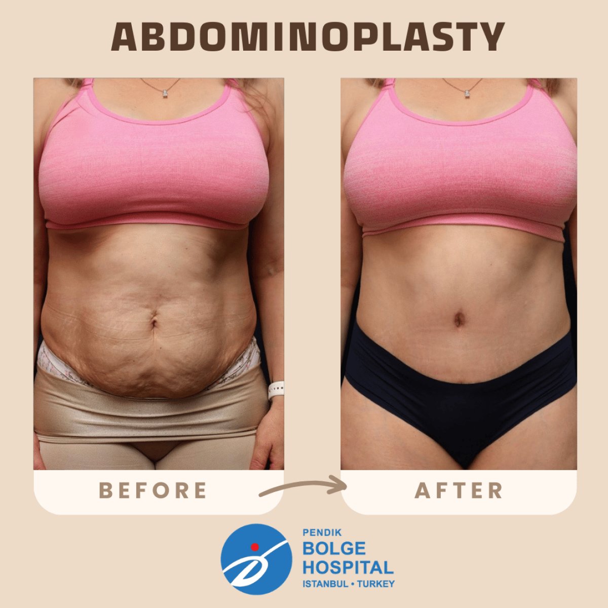Before and after tummy tuck results at Bolge Hospital, visible abdominal contour improvement