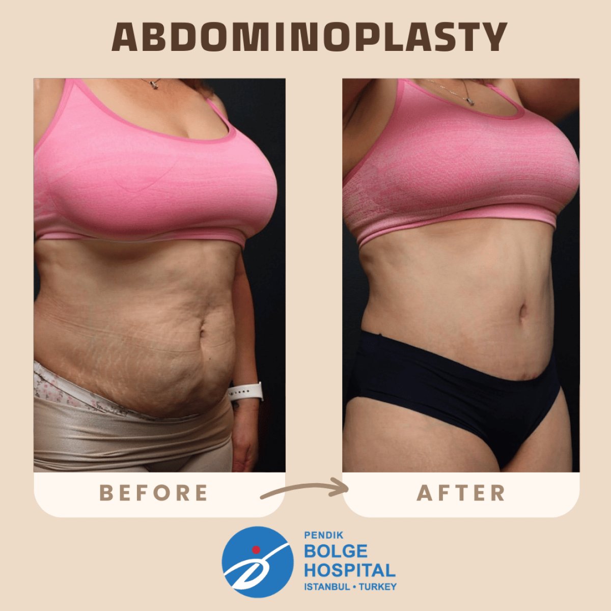 Résultats avant/après abdominoplastie à Bolge Hospital – amélioration du contour abdominal