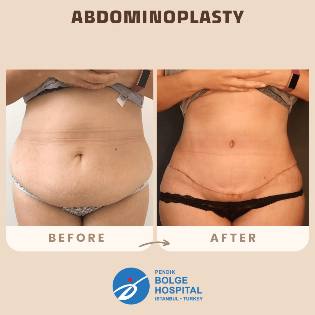 Before and after tummy tuck results at Pendik Bolge Hospital – visible abdominal contouring