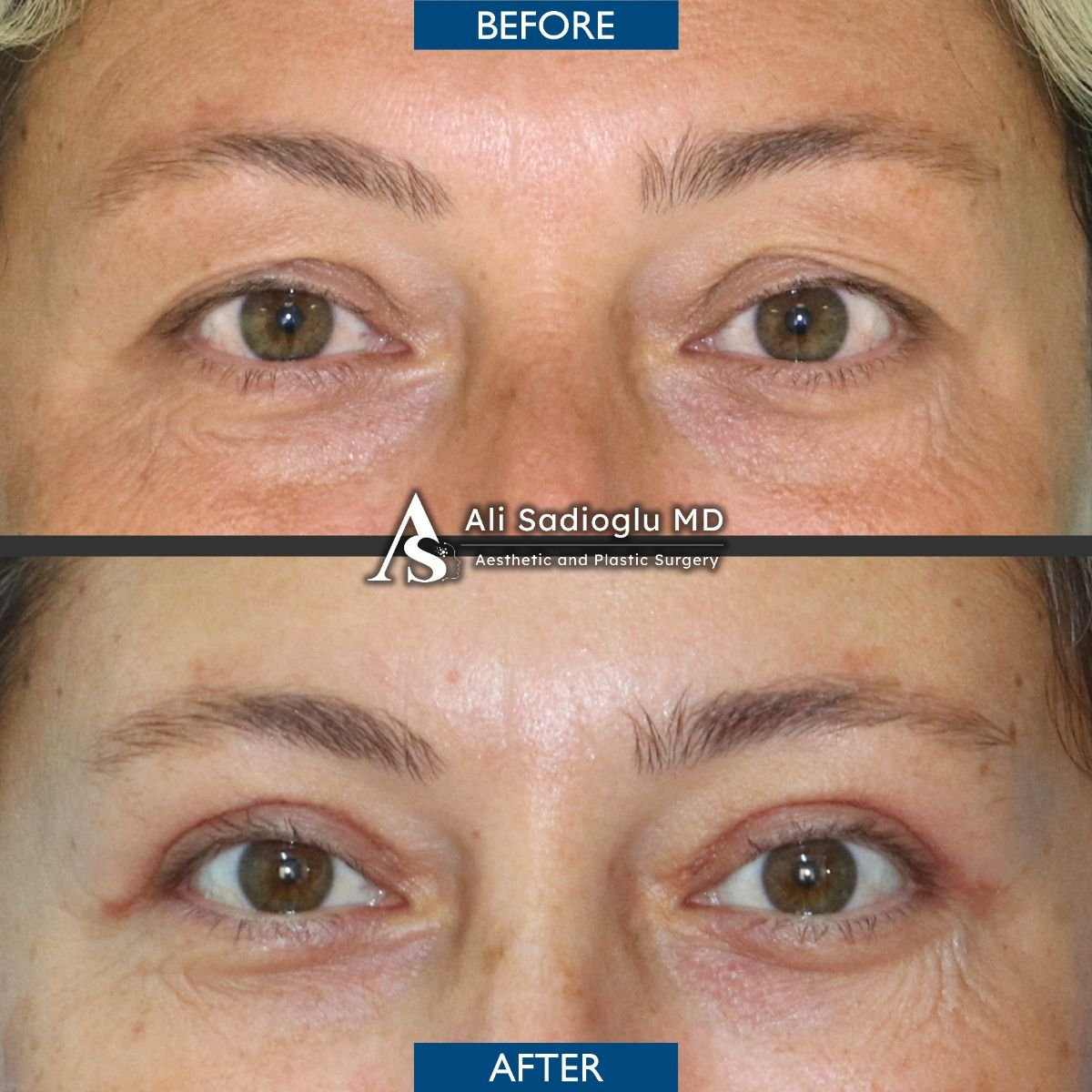 Resultados de blefaroplastia antes y después en Dr. Safa Manav Clinic, mejora de párpados