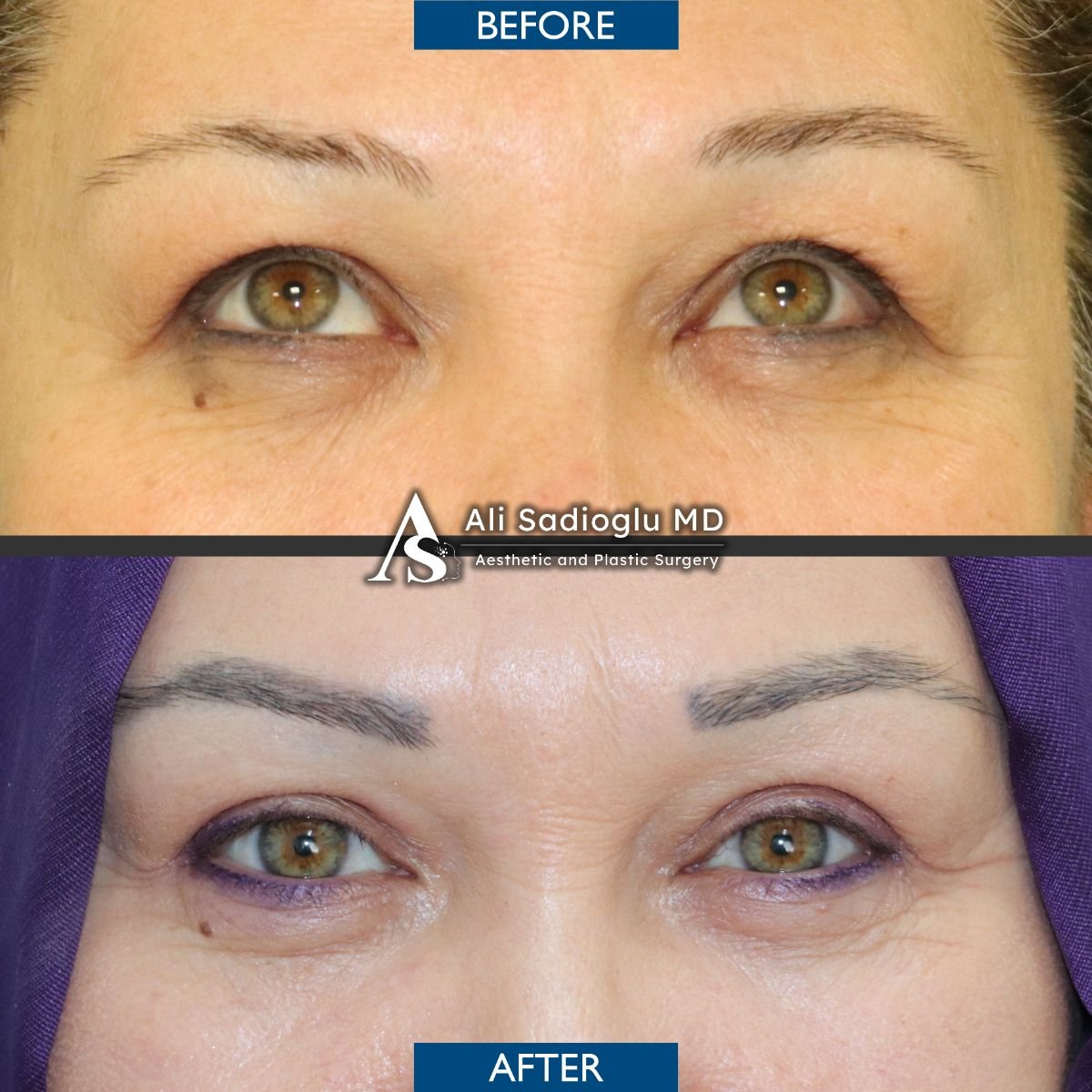 نتائج رأب الجفن قبل وبعد في عيادة Dr. Safa Manav، تصحيح الجفون
