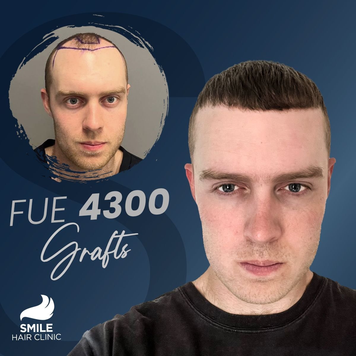 FUE 4300 grafts hair transplant before and after result at Smile Hair Clinic Turkey