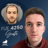 صور قبل وبعد زراعة الشعر للدكتور 