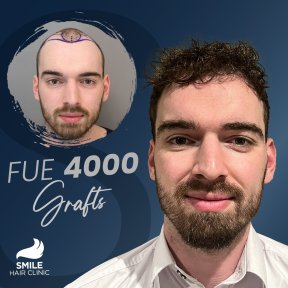 Sapphire FUE Hair Transplant with PRP - photo 6