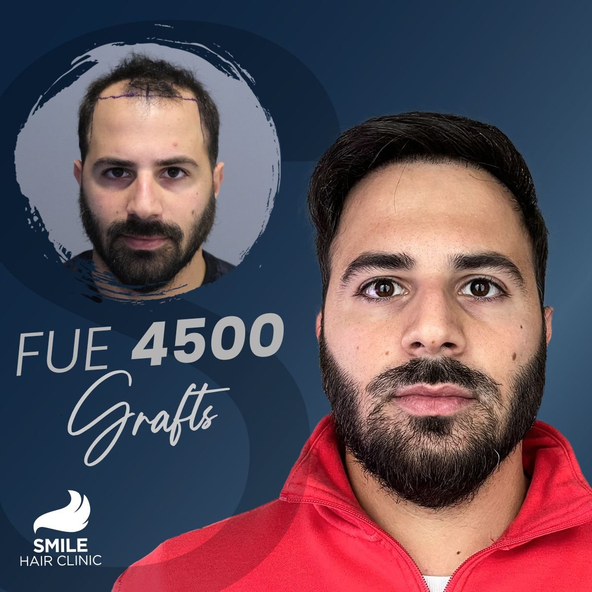 Efekt przeszczepu włosów FUE 4500 graftów przed i po w Smile Hair Clinic Turcja