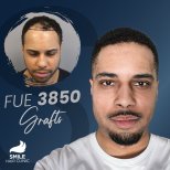 Before and after Hair transplant photos by Dr. 