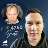 صور قبل وبعد زراعة الشعر للدكتور 