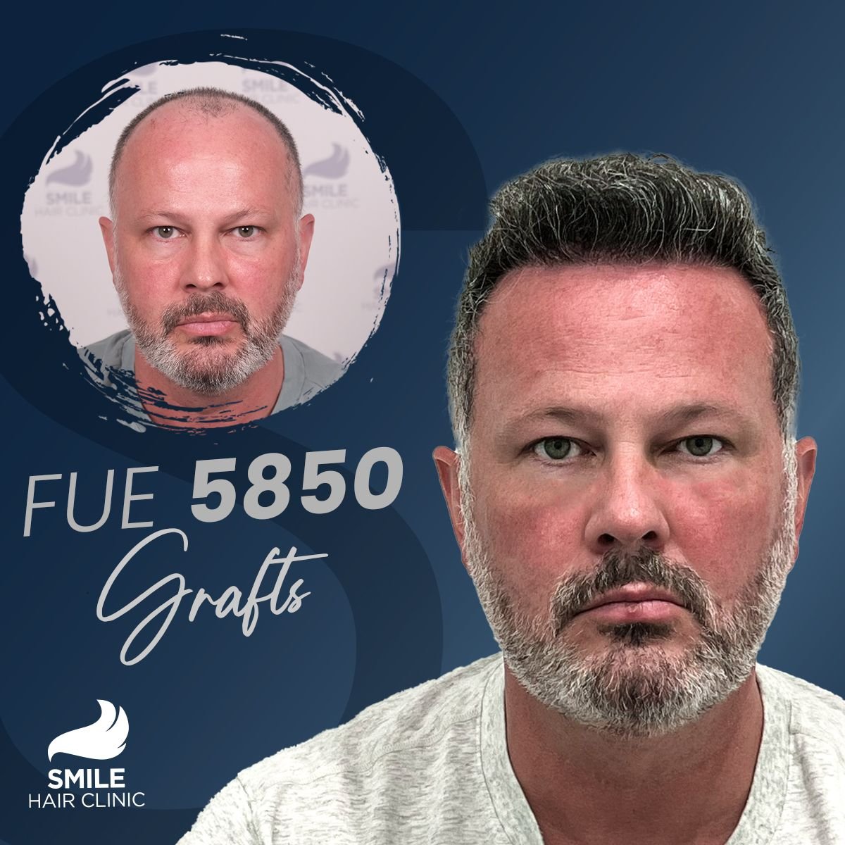 FUE hair transplant 5850 grafts before and after result at Smile Hair Clinic Turkey