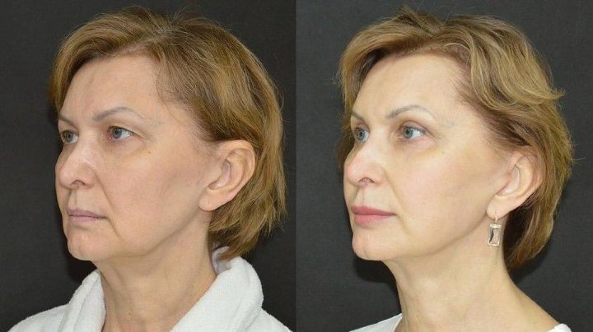 Resultados de blefaroplastia superior antes y después en Dmytrii Homola Clinic, rejuvenecimiento ocular