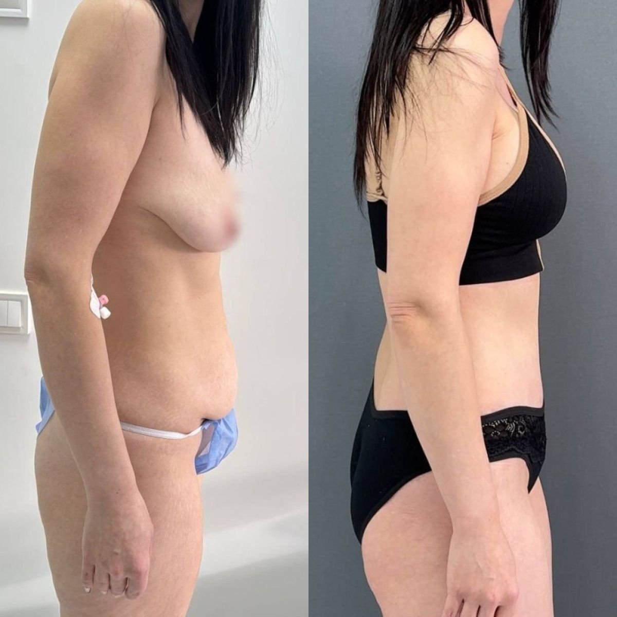 Before and after full body lift results at Dmytrii Homola Clinic, improved body contour