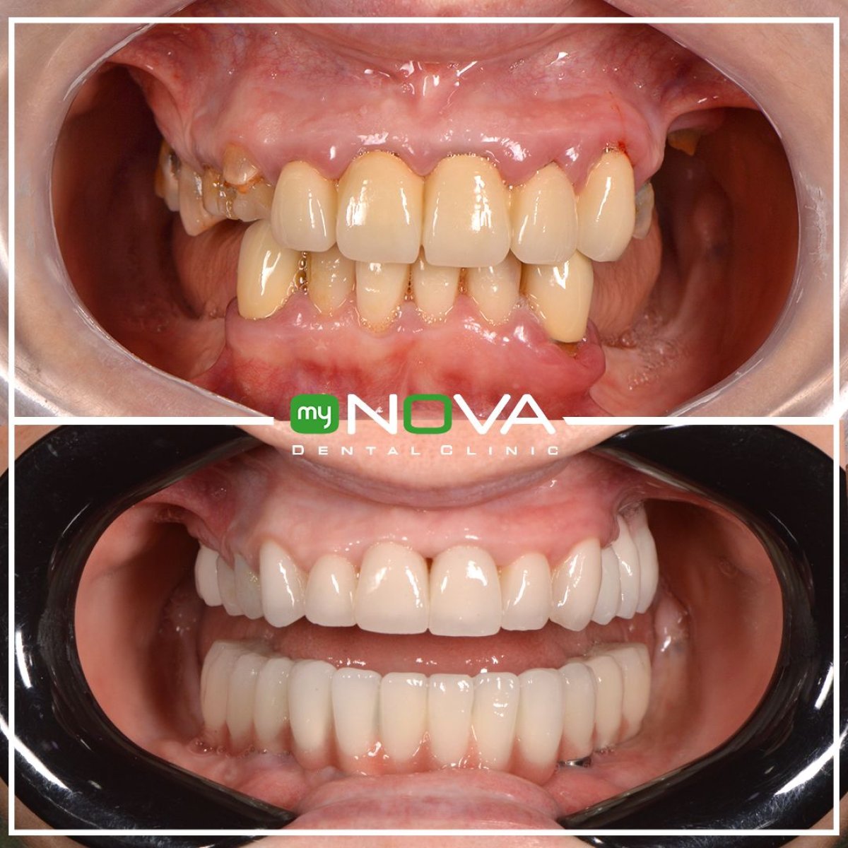 نتائج قبل وبعد الفينير في My Nova Kusadasi Dental Clinic، تحول الابتسامة