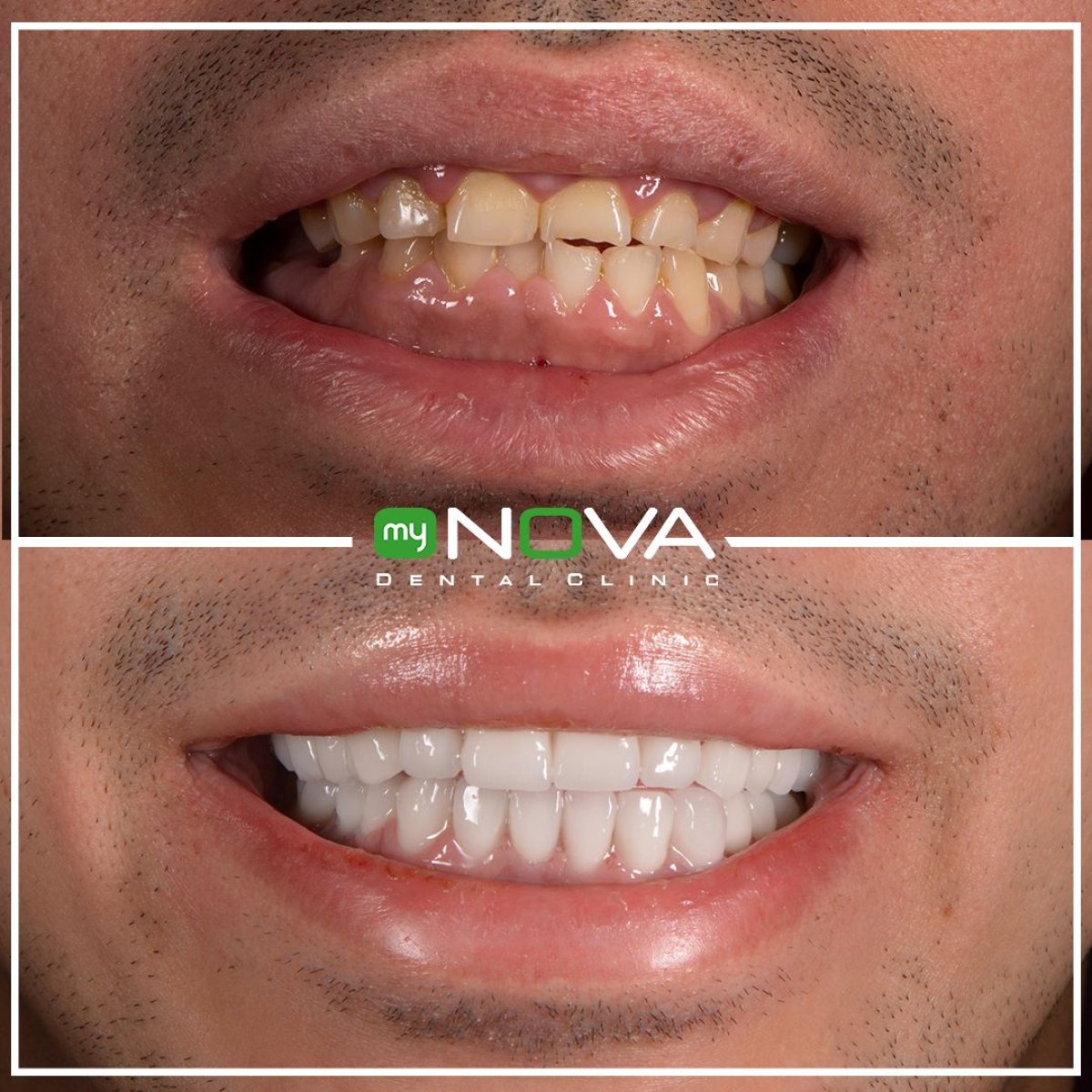 نتيجة قبل وبعد الفينير في My Nova Kusadasi Dental Clinic، تحول الابتسامة