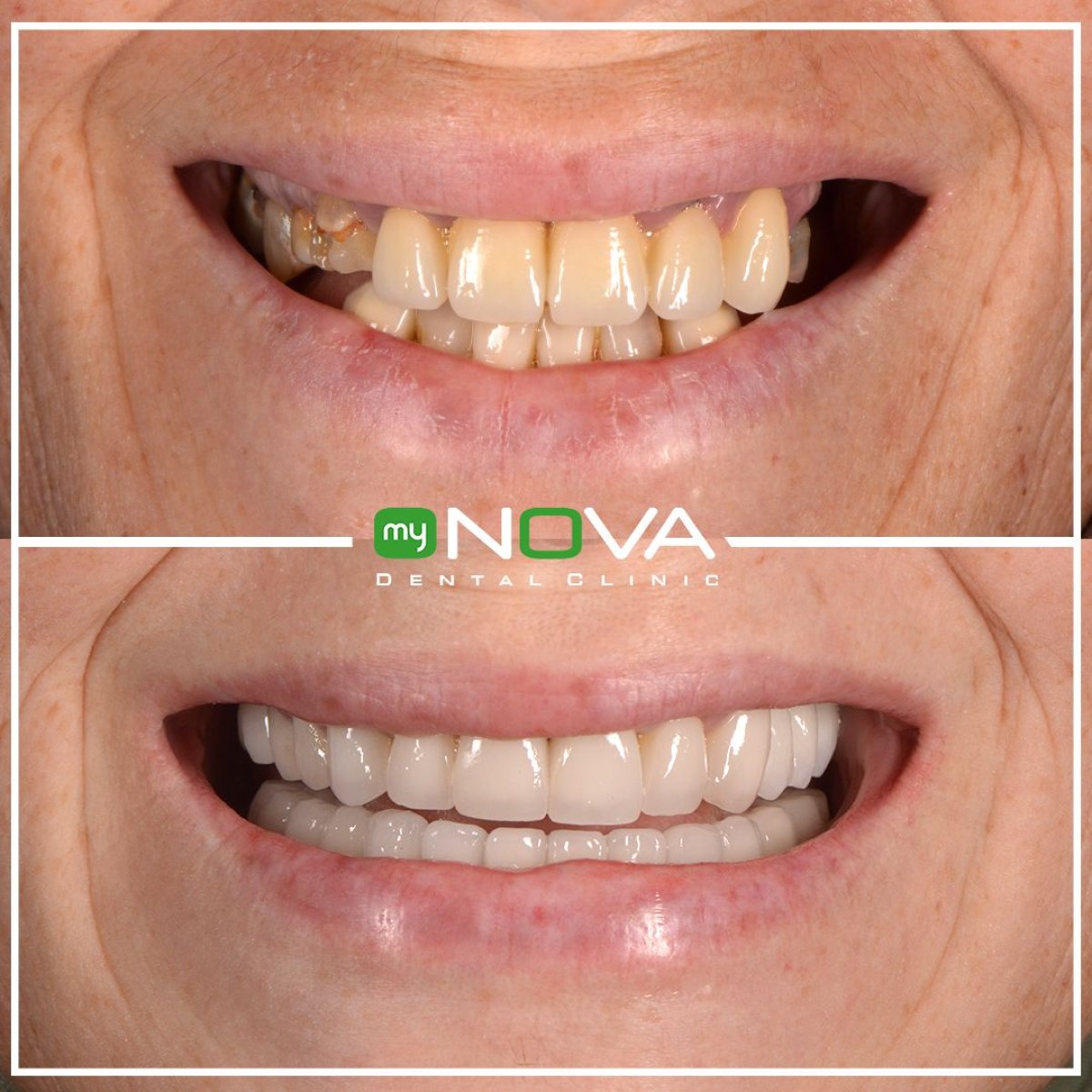 Before and after veneers at My Nova Kusadasi Dental Clinic, smile makeover results