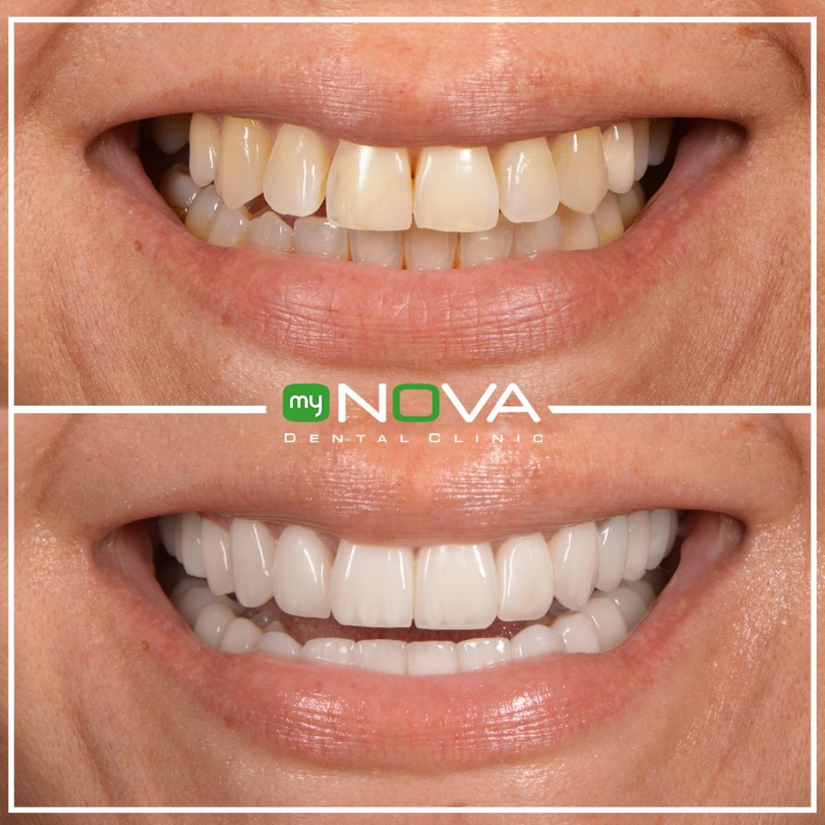 Before and after veneers at My Nova Kusadasi Dental Clinic, smile transformation result