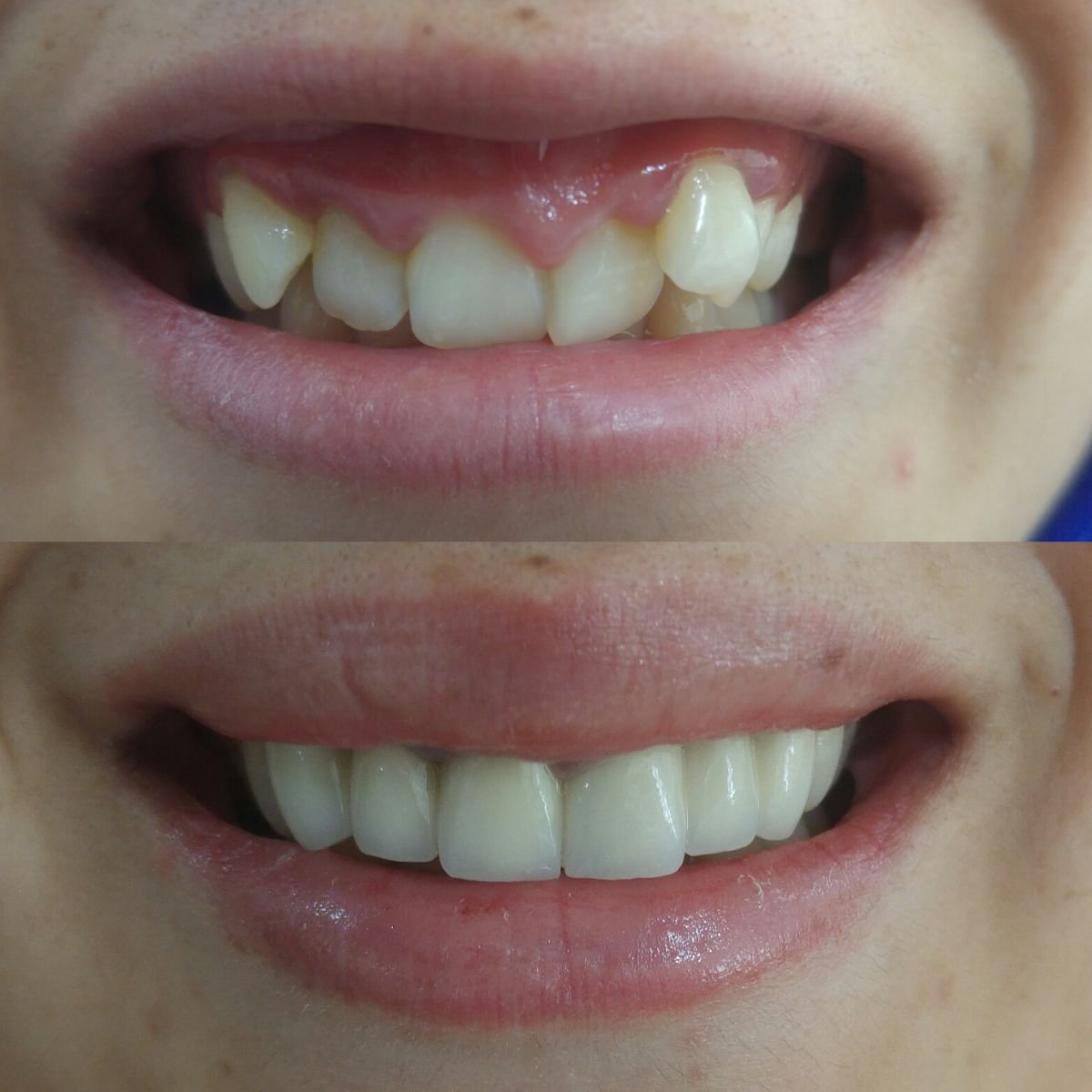 Before and after veneers at My Nova Kusadasi Dental Clinic, smile makeover results