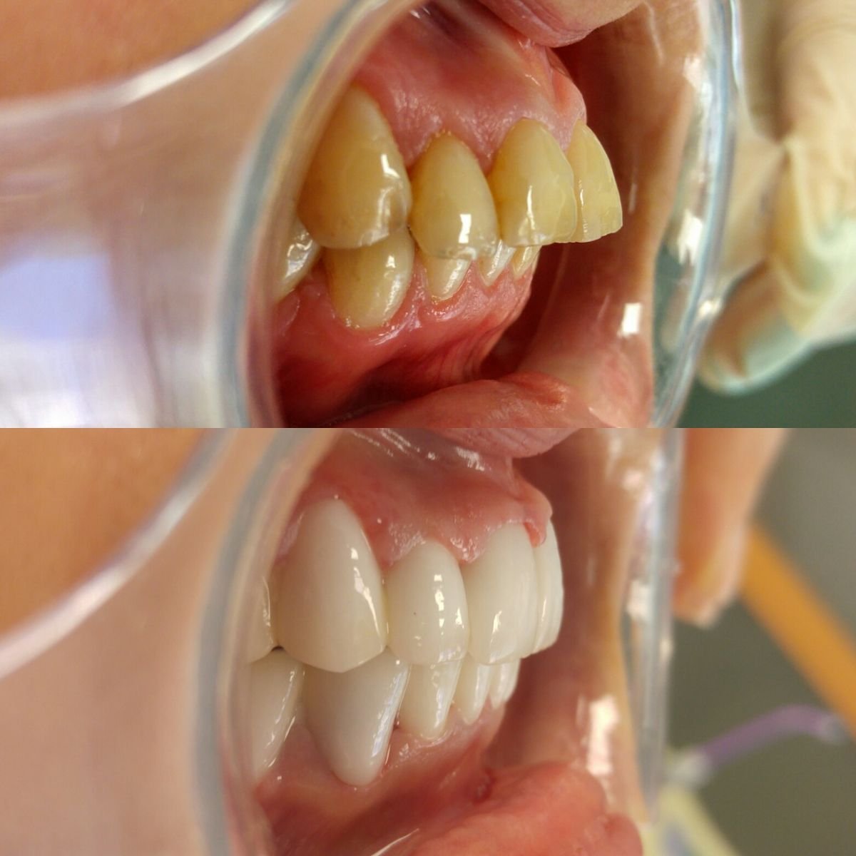 Before and after veneers result at My Nova Kusadasi Dental Clinic, smile transformation