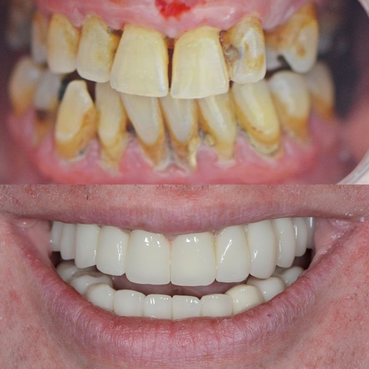 Przed i po licówkach w My Nova Kusadasi Dental Clinic, widoczna metamorfoza uśmiechu