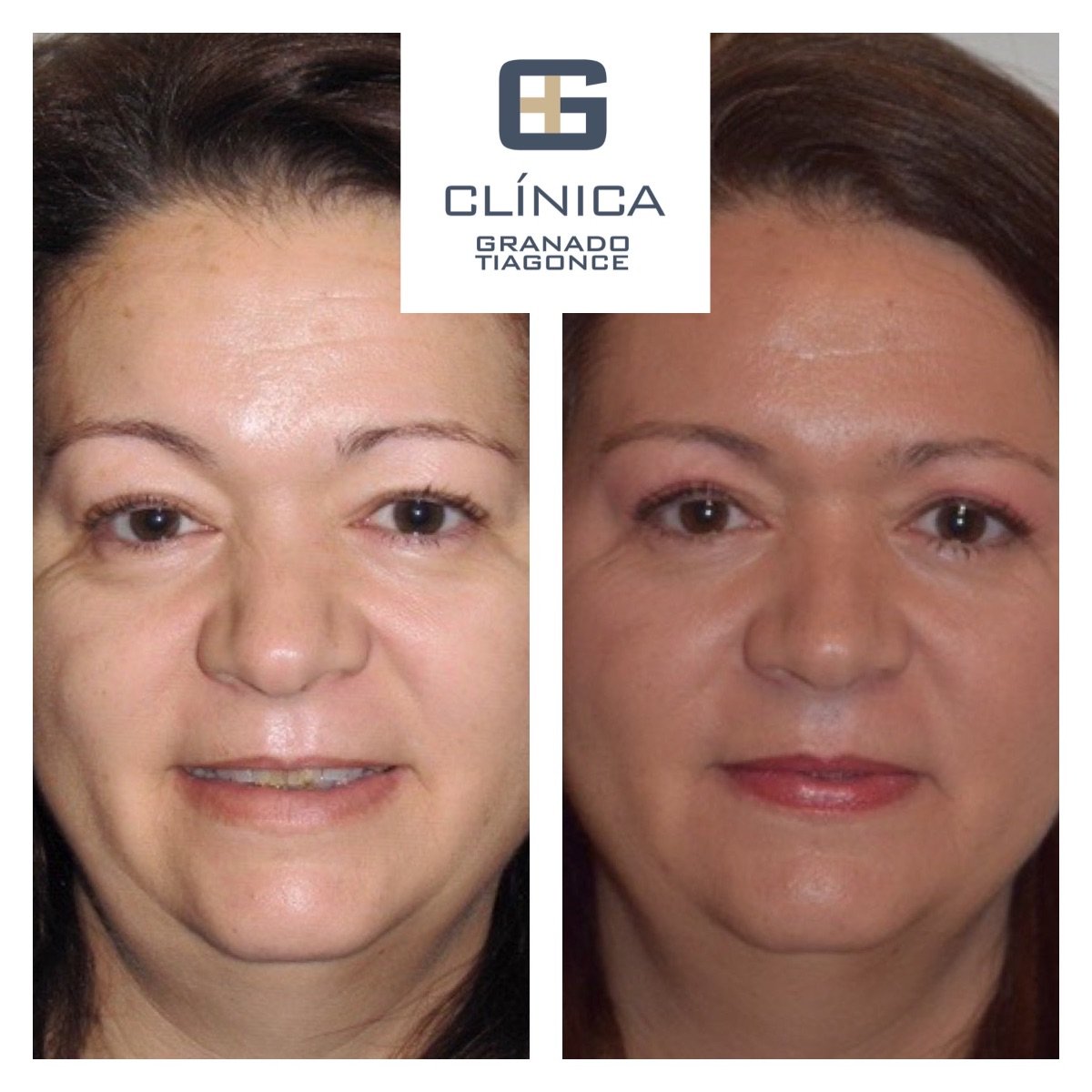 نتائج قبل وبعد شد الوجه العميق في Clinica Granado Tiagonce، تجديد شباب الوجه