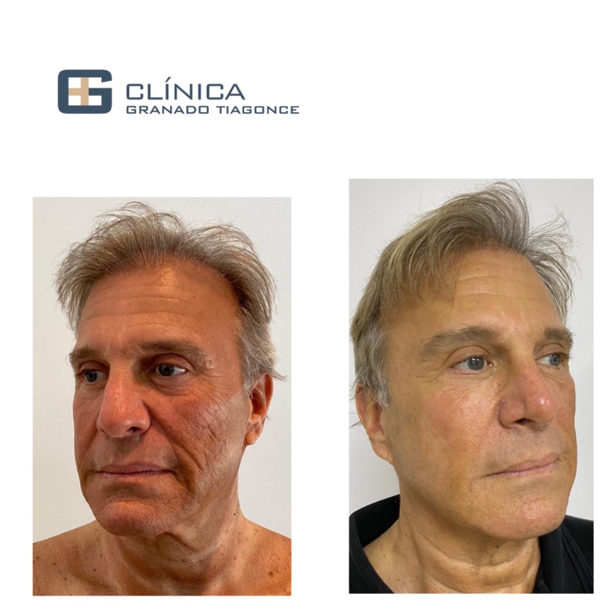 نتائج شد الوجه العميق قبل وبعد في Clinica Granado Tiagonce، تجديد شباب الوجه