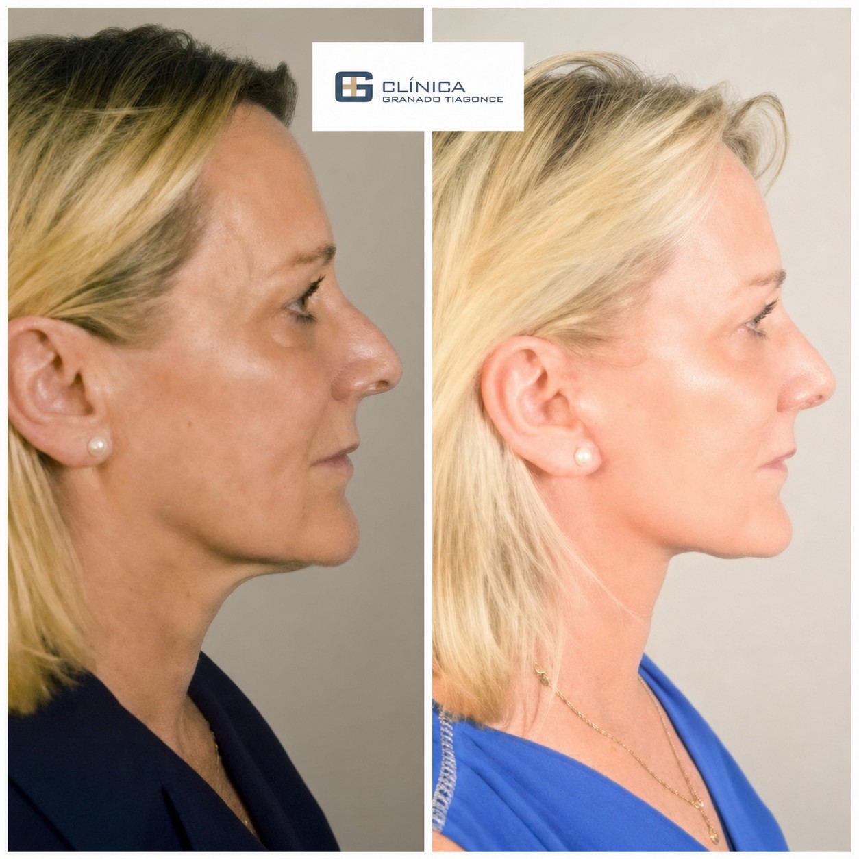 Résultats avant/après lifting deep plane à Clinica Granado Tiagonce, rajeunissement du visage