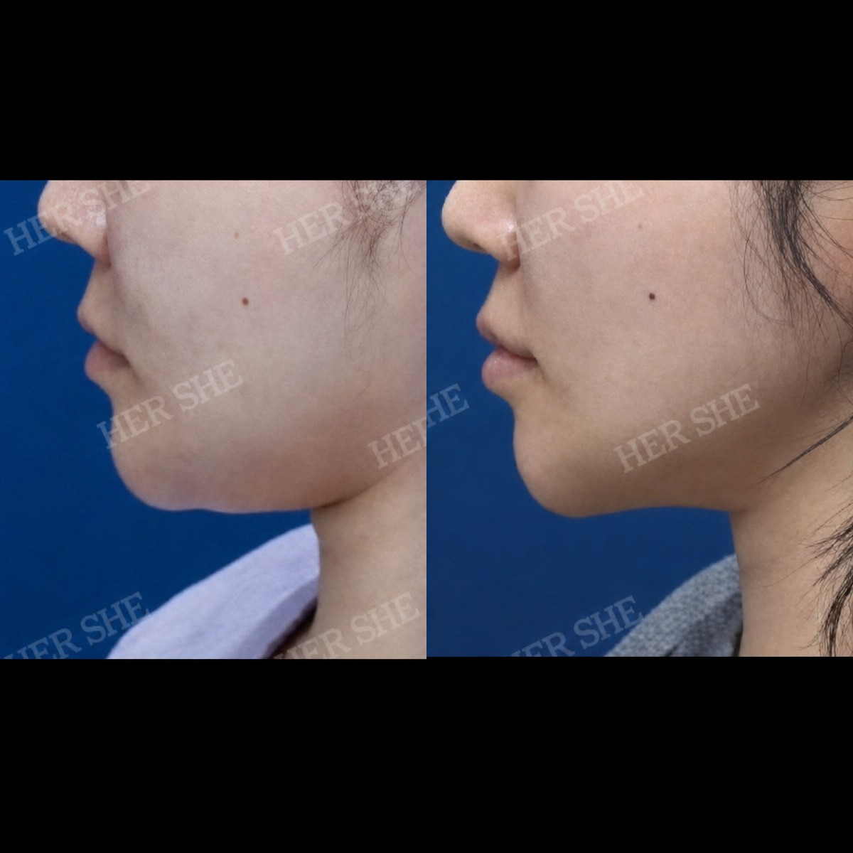 Результаты подтяжки нитями до и после в HERSHE Plastic Surgery Korea, коррекция линии челюсти