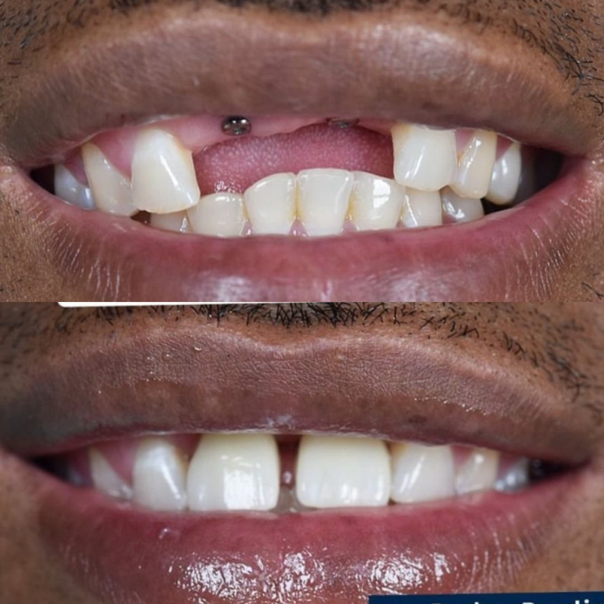 Before and after dental implant results at Paulino Almonte Dental Team, restored smile