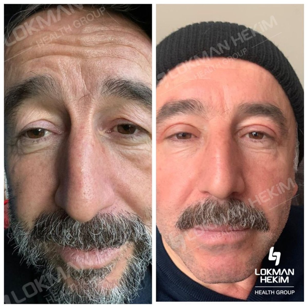 Before and after blepharoplasty results at Lokman Hekim University Ankara Hospital, eyelid lift