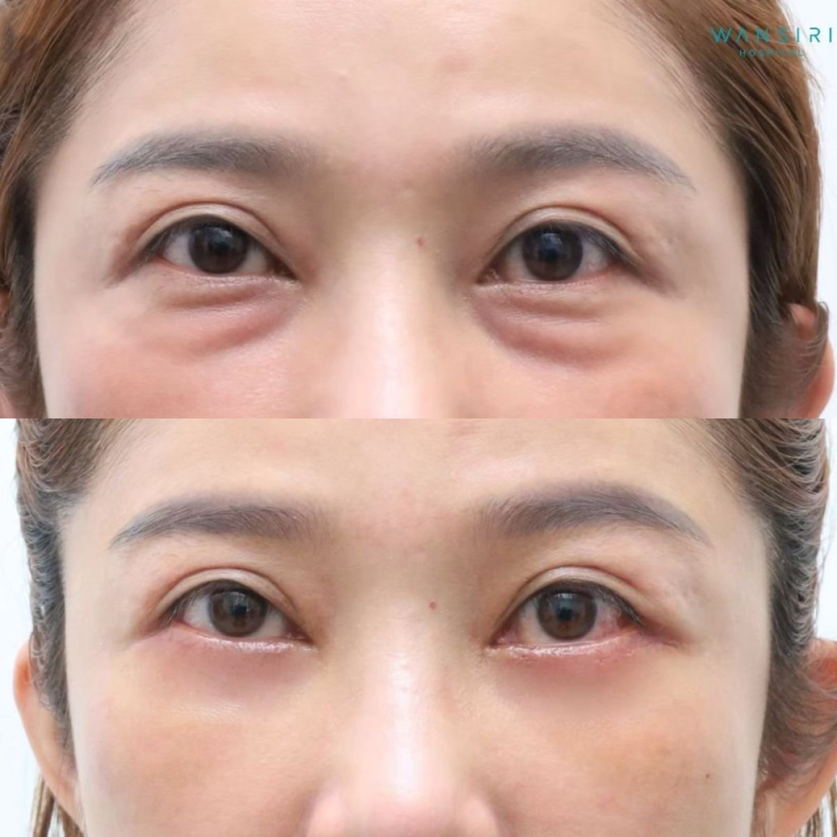 Before and after lower eyelid blepharoplasty results at Wansiri Hospital, reduced eye bags
