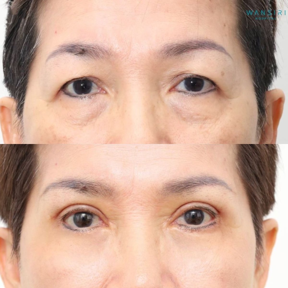 Resultados de blefaroplastia de párpado inferior antes y después en Wansiri Hospital, menos bolsas
