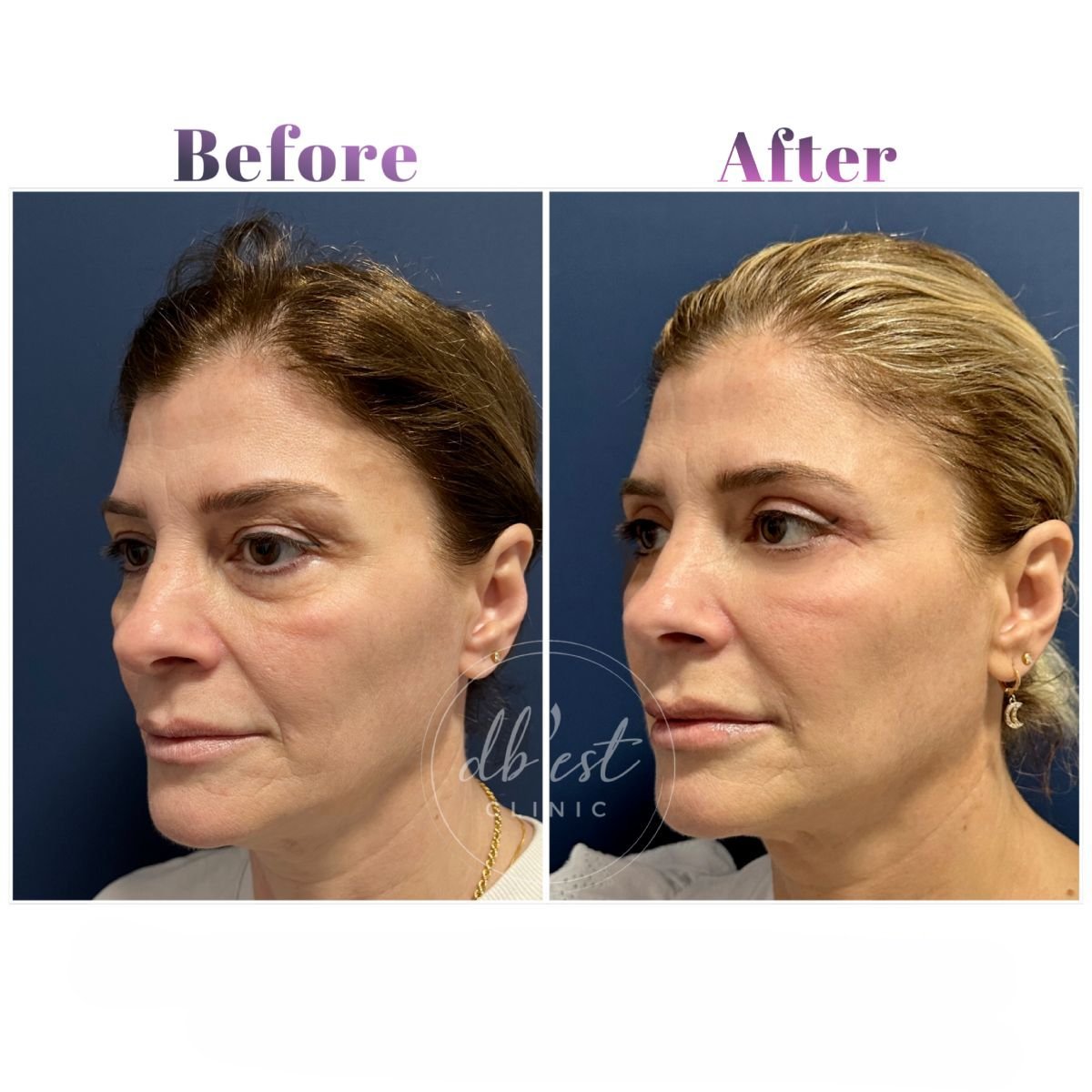 Before and after facial fat transfer at Db'est Clinic, visible facial volume restoration result