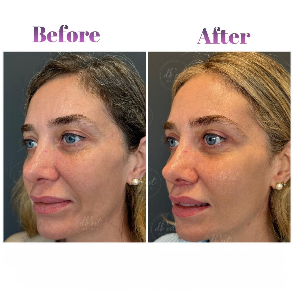 Before and after facial fat transfer at Db'est Clinic, visible facial volume enhancement result