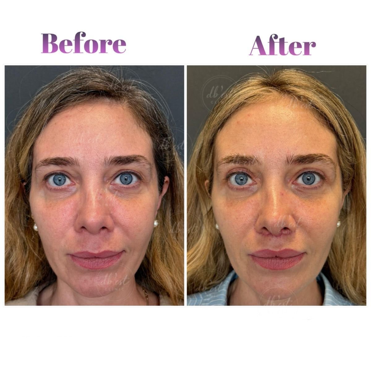 Before and after facial fat transfer results at Db'est Clinic – enhanced facial volume