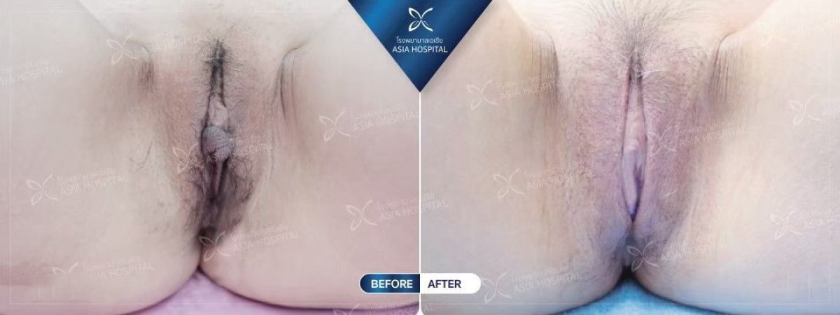 Résultats avant et après labiaplastie à Asia Cosmetic Hospital, aspect des lèvres amélioré