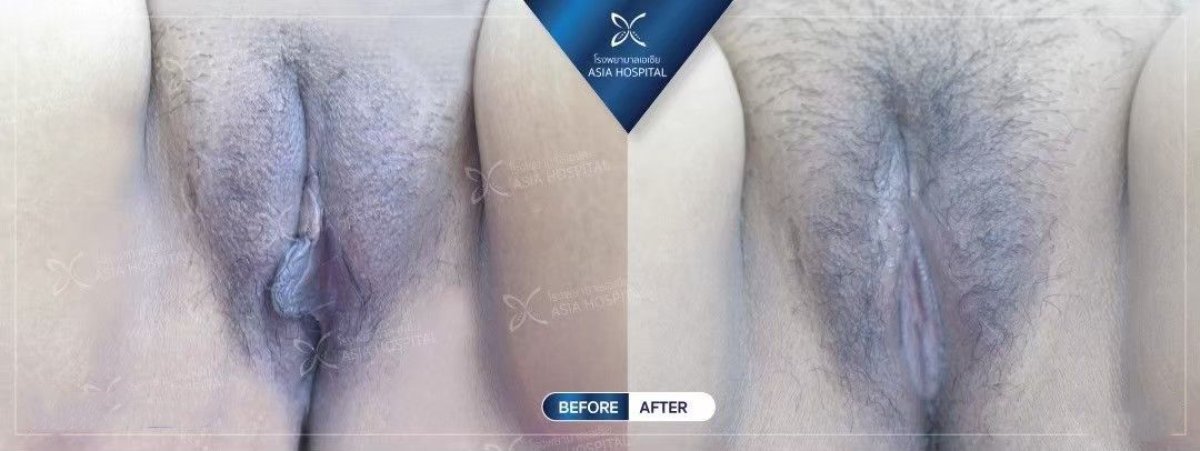 Before and after labiaplasty results at Asia Cosmetic Hospital, improved labia appearance