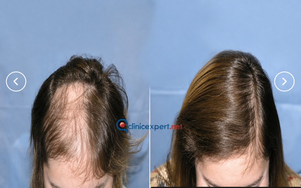 Результати до і після No Shave Hair Transplant у CE International Hospital для жінок