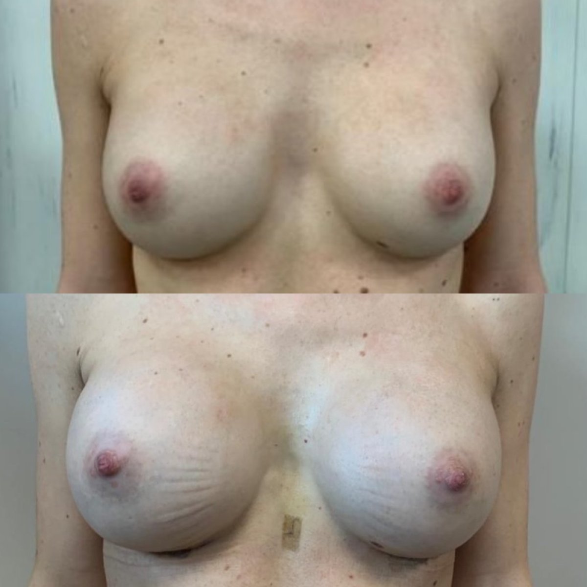 Résultats avant/après implants mammaires avec lifting à Memorial Antalya Hospital, forme améliorée