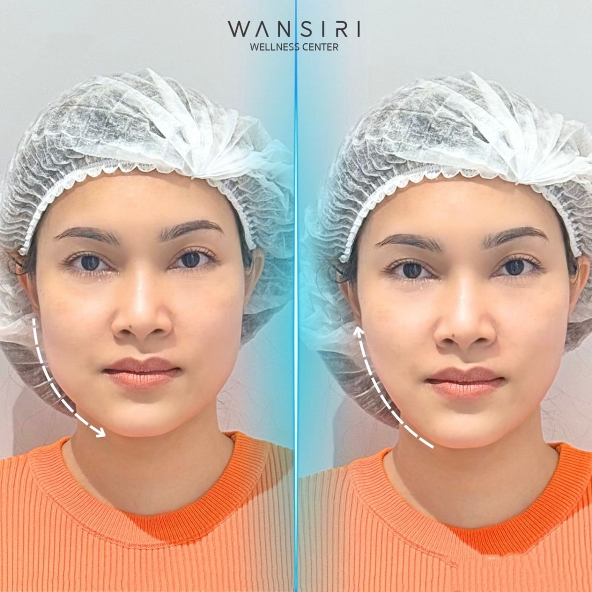 Resultados de Ultherapy antes y después en Wansiri Hospital – contorno facial más firme