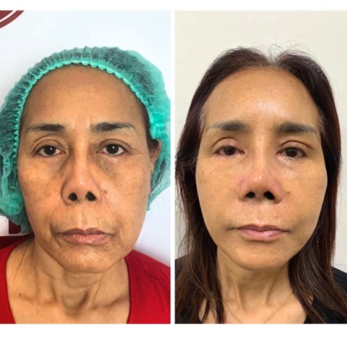 Facial fat transfer before and after results at DGB Clinic, improved facial volume and contour