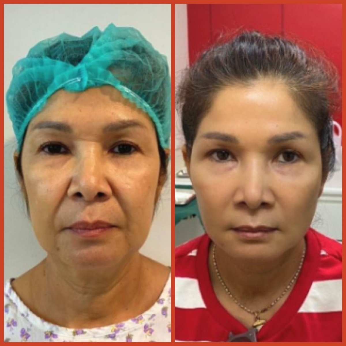 Before and after facelift results at DGB Clinic, visible facial rejuvenation and tighter skin