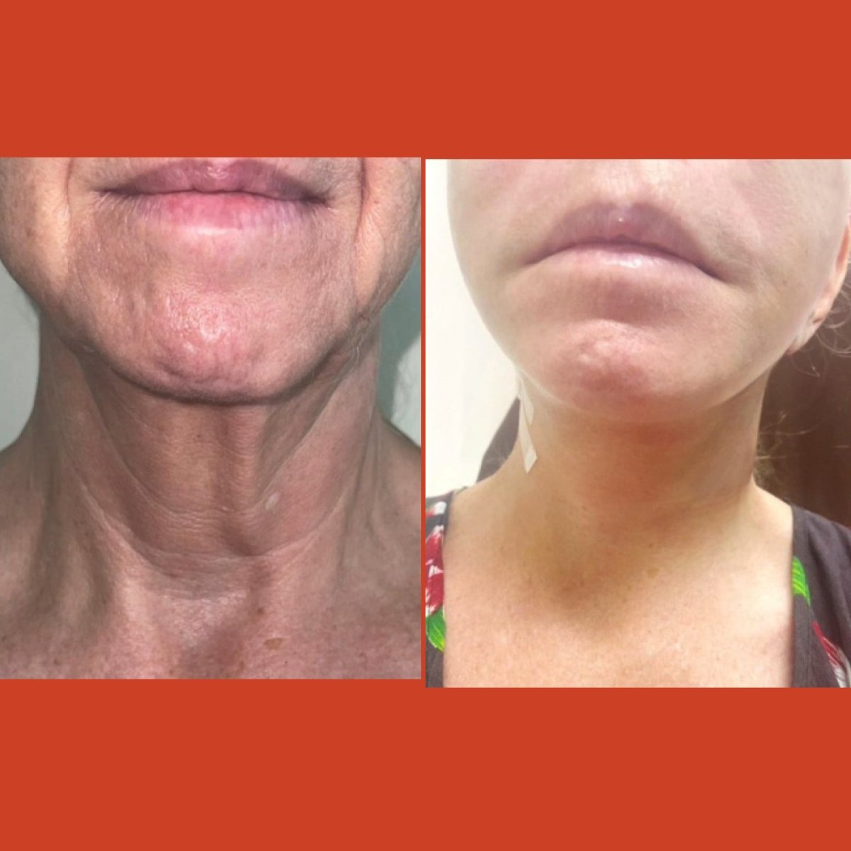 Resultados de lifting de cuello antes y después en DGB Clinic – contorno mejorado y piel firme