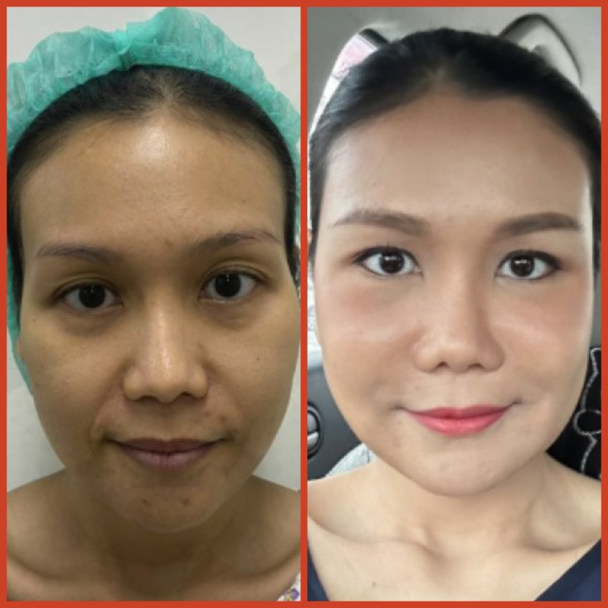 Before and after facial fat transfer results at DGB Clinic, enhanced facial volume and contour